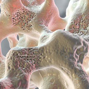 Osteoporosis Image 2 min