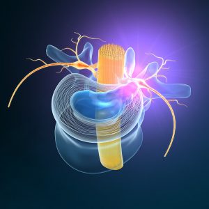 Pinched Nerve Image 2 min